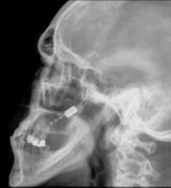 Imagen: El sistema de neuroestimulación ATI (Fotografía cortesía de Autonomic Technologies).